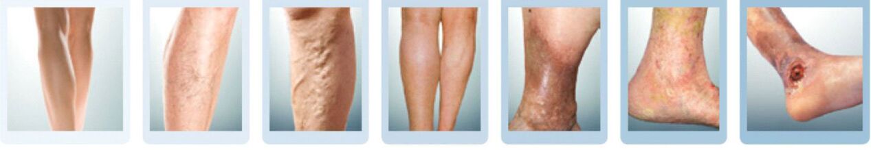 Fases do desenvolvemento das varices das pernas