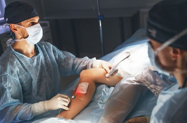 Cirurxía de varices cun láser