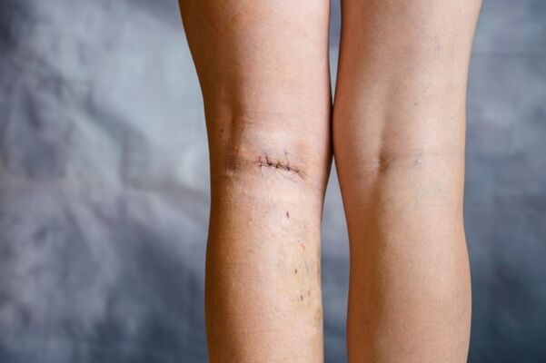 Sutura na perna despois da cirurxía de varices