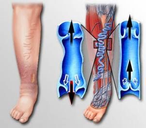 Circulación sanguínea na perna con varices
