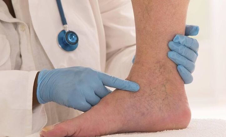 o doutor examina a perna con varices