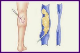 A escleroterapia é unha forma popular de desfacerse das varices nas pernas