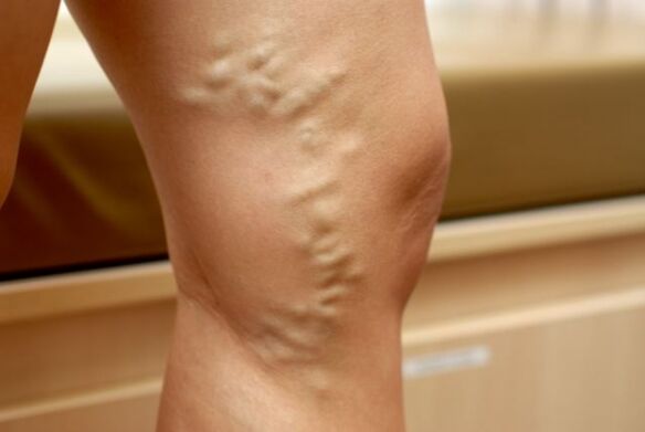 Varices na perna con varices da pelve