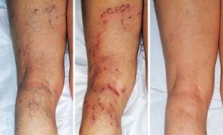 Síntomas de varices nas pernas