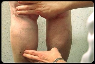 O doutor examina as pernas con varices