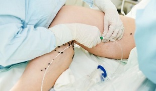 Métodos de tratamento de varices nas pernas en mulleres